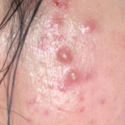 Sandra Yeh , MD - I came to her to treat my acne scar, which consultation made worse and gave me more acne
