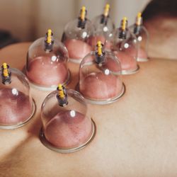 Luxx Med Aesthetics & Wellness - Cupping Therapy in session