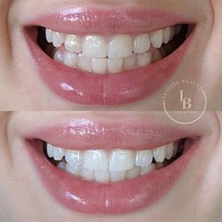 Infinite Beauty Orlando - Teeth Whitening. Results after one 1/2 of a session.