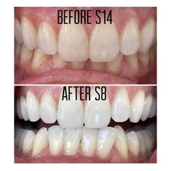 White Teeth Fast