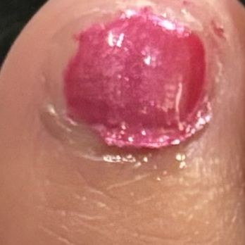 Mancini De Paris - Close up of my ring toe on my left foot... - Hair Salons Near Me - Arlington, Virginia Mancini De Paris - Close up of my ring toe on my left foot... - Hair Salons Near Me - Arlington, Virginia