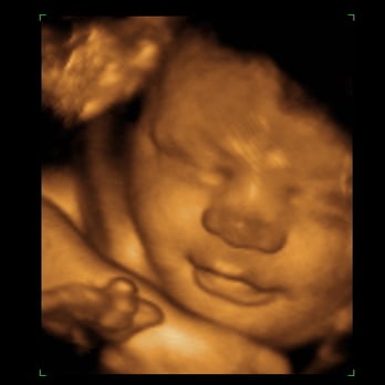 Clearview Ultrasound - Our sweet son at 33 weeks - Ultrasound Imaging Centers Near Me - Round Rock, Texas