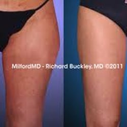 Affordable Lipo Sacramento