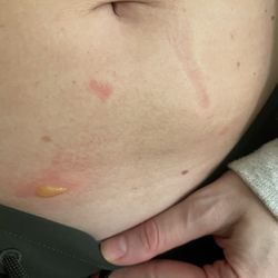 New Horizon Center For Cosmetic Surgery - Blister post Emsculpt Neo