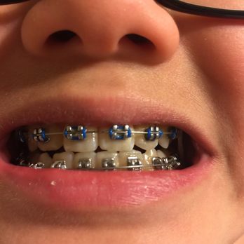 Diamond Braces - Orthodontists Near Me - Hackensack, New Jersey