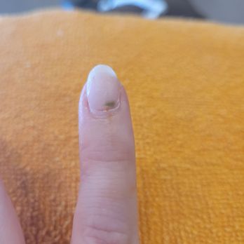 Stella Nails & Spa - Fungus and cut in nail bed after dip removal. - Nail Salons Near Me - Los Angeles, California Stella Nails & Spa - Fungus and cut in nail bed after dip removal. - Nail Salons Near Me - Los Angeles, California