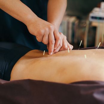Kent Chiro Med Wellness Clinic - Therapist performing acupuncture - Chiropractors Near Me - Ottawa, Ontario Kent Chiro Med Wellness Clinic - Therapist performing acupuncture - Chiropractors Near Me - Ottawa, Ontario