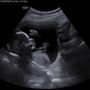 Photo of Gender Reveal HD Ultrasound