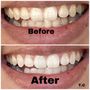 Photo of Smile Again Teeth Whitening