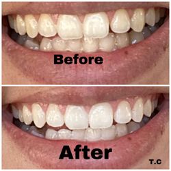 Smile Again Teeth Whitening