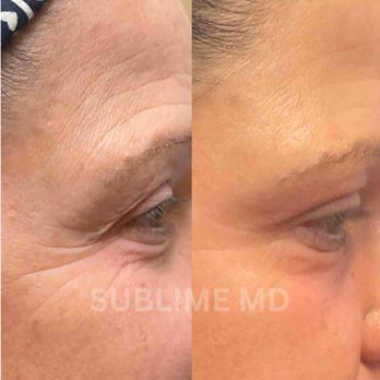 Sublime Medical Aesthetics - Soften fine lines/wrinkles with CO2 resurfacing around the eyes - Laser Hair Removal Near Me - Riverside, California Sublime Medical Aesthetics - Soften fine lines/wrinkles with CO2 resurfacing around the eyes - Laser Hair Removal Near Me - Riverside, California