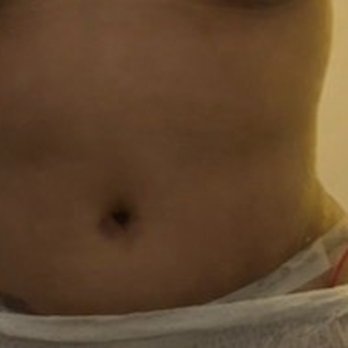 Nip Tuck Aesthetics - Same hip from the gecko was off - Plastic Surgeons Near Me - Miami, Florida Nip Tuck Aesthetics - Same hip from the gecko was off - Plastic Surgeons Near Me - Miami, Florida