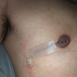 Olympic Plastic Surgery Center - Not sure why he needed to make another scar when he could have put the drain through the existing incision he made. Those are my thoughts.