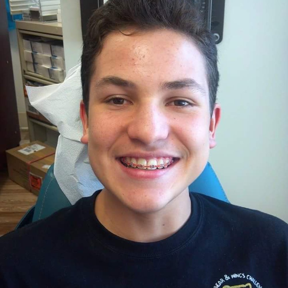 Stephen J Giovanisci, DDS - Braces almost halfway - Orthodontists Near Me - Montrose, California Stephen J Giovanisci, DDS - Braces almost halfway - Orthodontists Near Me - Montrose, California