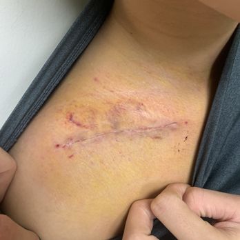 Kevin Luke, MD - 8 Days after surgery. - Orthopedists Near Me - Palos Heights, Illinois Kevin Luke, MD - 8 Days after surgery. - Orthopedists Near Me - Palos Heights, Illinois