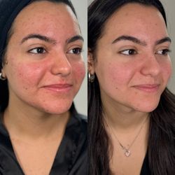 The Glo Company - Microneedling with skinbooster for acne and rosacea.