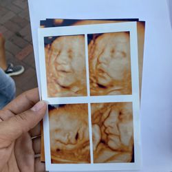 A Precious Glimpse - 4D ultrasound