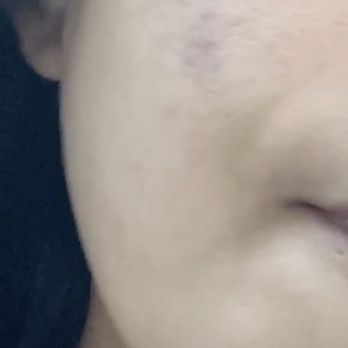MOI Beauty Spa - This is before my treatment . I will update in a couple days - Medical Spas Near Me - El Monte, California MOI Beauty Spa - This is before my treatment . I will update in a couple days - Medical Spas Near Me - El Monte, California