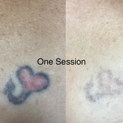 Oasis MedSpa - Tattoo removal one session