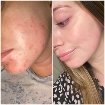Sand Dermatology - Left is 2 weeks before starting isotretinoin, right is after - Dermatologists Near Me - Chino Hills, California