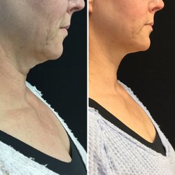 Butterfly Medical Spa - Coolsclupting for double chin treatment
