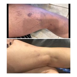 Schulman Vein and Laser Center - In less than 2 months. Side and back of leg.