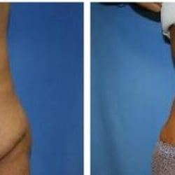 Coley Cosmetic & Hand Surgery Center - Tummy Tuck Before & After
