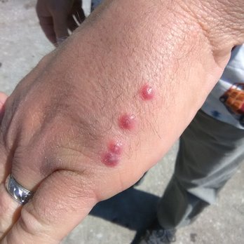 Red Roof Inn - My husbands bed bug bites the next day, swollen and painfully itchy, courtesy of Red Roof Inn - Hotels Near Me - Albany, Georgia Red Roof Inn - My husbands bed bug bites the next day, swollen and painfully itchy, courtesy of Red Roof Inn - Hotels Near Me - Albany, Georgia
