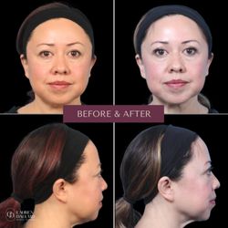 Lauren Daly, MD - The Natural Result Center - Before and after of upper blepharoplasty (upper eyelid lift).