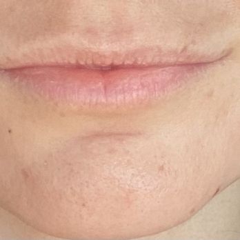 High Desert Dermatology - Before Juvederm - Skin Care Near Me - Reno, Nevada