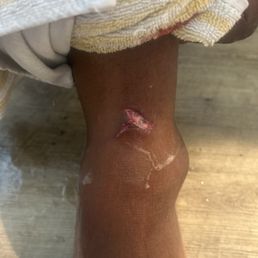 Bite where dog latched on and would not get off. 3 stitches and infection. Bite where dog latched on and would not get off. 3 stitches and infection.