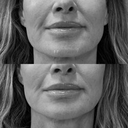 Source Of Health - Chin filler improves facial balance and enhances natural beauty!