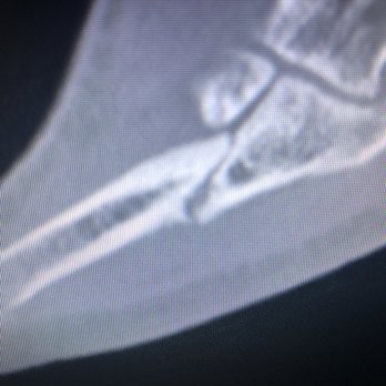 Barrington Orthopedic Specialists - Still not healed 5 months later - Orthopedists Near Me - Schaumburg, Illinois Barrington Orthopedic Specialists - Still not healed 5 months later - Orthopedists Near Me - Schaumburg, Illinois