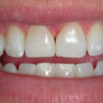 Steven G Kolokithas, DDS - Post-op bonding - General Dentistry Near Me - Rogers, Arkansas Steven G Kolokithas, DDS - Post-op bonding - General Dentistry Near Me - Rogers, Arkansas