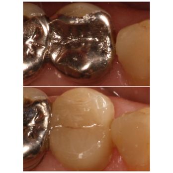 Jared Plitt, DMD - High strength ceramic onlays - General Dentistry Near Me - Miami Beach, Florida Jared Plitt, DMD - High strength ceramic onlays - General Dentistry Near Me - Miami Beach, Florida