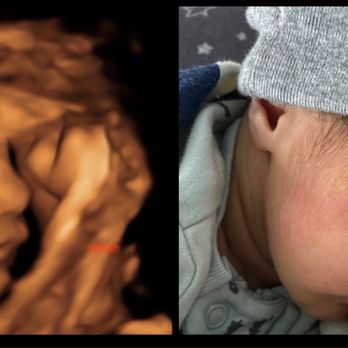Next Generation Prenatal Imaging - Comparing 3D ultrasound and newborn :) - Ultrasound Imaging Centers Near Me - Elk Grove, California Next Generation Prenatal Imaging - Comparing 3D ultrasound and newborn :) - Ultrasound Imaging Centers Near Me - Elk Grove, California