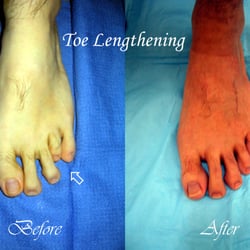 Ashkan Soleymani, DPM - Toe Lengthening (Before & After)