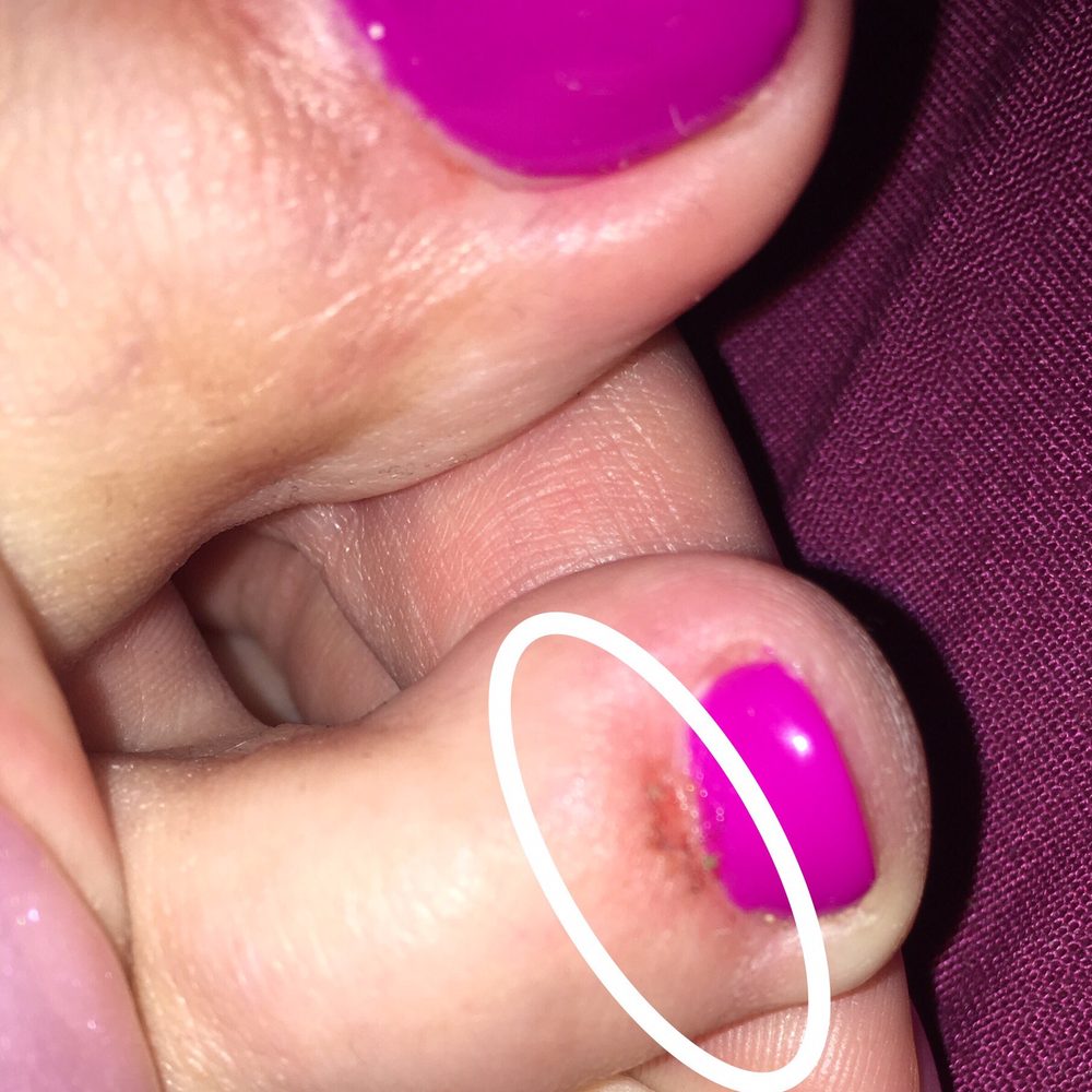 Crescent Nail and Spa - Cut & raw cuticle after bleeding - Nail Salons Near Me - Vancouver, British Columbia Crescent Nail and Spa - Cut & raw cuticle after bleeding - Nail Salons Near Me - Vancouver, British Columbia