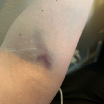 Quest Diagnostics - 24 hours after blood draw where my vein was blown up from too much tourniquet pressure - Laboratory Testing Near Me - Upland, California Quest Diagnostics - 24 hours after blood draw where my vein was blown up from too much tourniquet pressure - Laboratory Testing Near Me - Upland, California