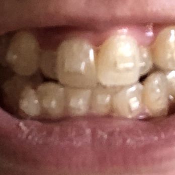 Floresta Plaza Dental - Beginning of treatment - General Dentistry Near Me - San Leandro, California