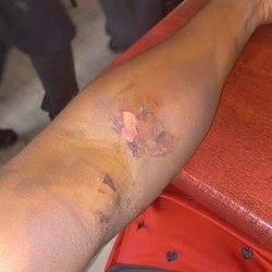 CSL Plasma - This is what happens to your arm when it starts to swell up and they have the nerve to ask me could they do the other one. Then deferred me