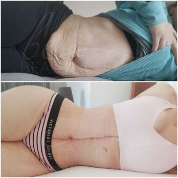 Dr. Carmina Cardenas - Lower Body Lift & Fleur de Lis, Muscle repair, liposuction and fat transfer to buttocks and hips - Cosmetic Surgeons Near Me - Tijuana, BCN Dr. Carmina Cardenas - Lower Body Lift & Fleur de Lis, Muscle repair, liposuction and fat transfer to buttocks and hips - Cosmetic Surgeons Near Me - Tijuana, BCN
