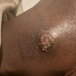 St Johns Episcopal Hospital - Five staphylococcus infections HEAD