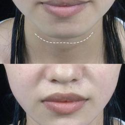 Akoya Aesthetics & Wellness - The power of Chin filler!