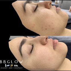 iCandy & Company - BBGLOW Facial