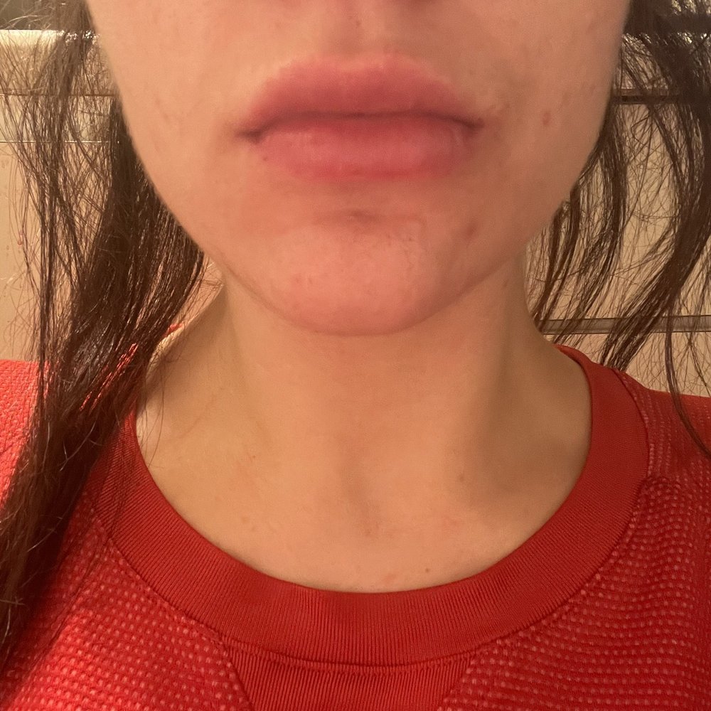 Allure Medical - After about a month and a half and me massaging the huge lump out myself - Medical Spas Near Me - Livonia, Michigan