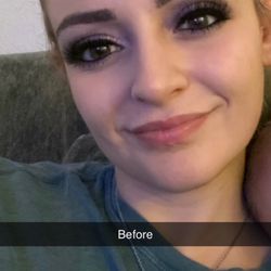 Michelle Norvell Aesthetics - Before michelle injected my nose