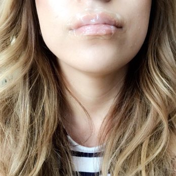 Glo Medspa - They leave this numbing cream on your lips for about 20 min. - Medical Spas Near Me - Scottsdale, Arizona Glo Medspa - They leave this numbing cream on your lips for about 20 min. - Medical Spas Near Me - Scottsdale, Arizona