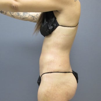 North Coast Plastic Surgery - 1 week post op pic of abdomen - Skin Care Near Me - Oceanside, California North Coast Plastic Surgery - 1 week post op pic of abdomen - Skin Care Near Me - Oceanside, California