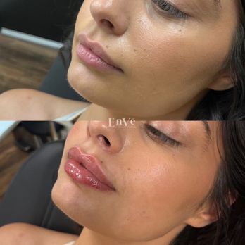 Enve California Aesthetics - Lip Filler by RN Taylor - Medical Spas Near Me - Tustin, California Enve California Aesthetics - Lip Filler by RN Taylor - Medical Spas Near Me - Tustin, California